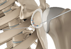 Arthroscopic Bankart Repair