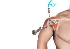 Thoracic Outlet Syndrome