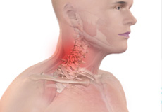 Thoracic Outlet Syndrome