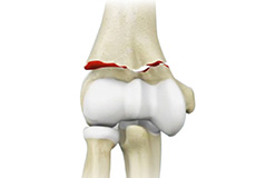 Elbow Fractures