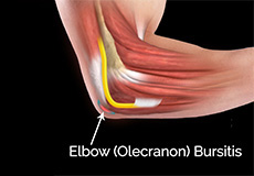 Elbow (Olecranon) Bursitis