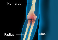 Thoracic Outlet Syndrome