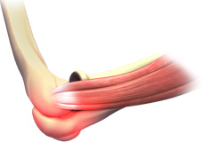 Thoracic Outlet Syndrome