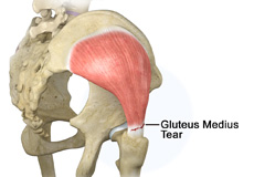 Gluteus Medius Tear