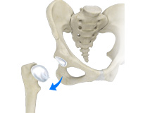 Hip Dislocation