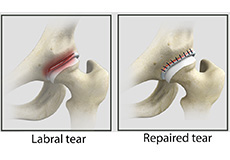 Hip Labral Repair