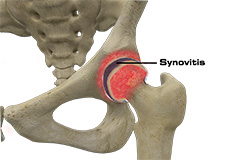 Hip Synovitis