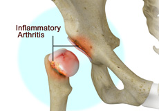 Inflammatory Arthritis of the Hip 