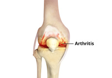 Anterior Knee Pain