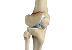 Anterior Knee Pain