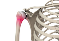 Thoracic Outlet Syndrome