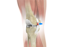 mcl-sprain