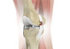 Anterior Knee Pain