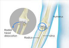 Thoracic Outlet Syndrome