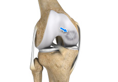 osteochondritis-dissecans