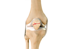 Anterior Knee Pain