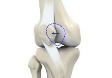 Anterior Knee Pain