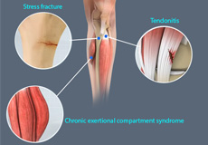 Anterior Knee Pain