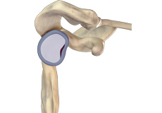 Shoulder Joint Tear