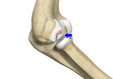 Thoracic Outlet Syndrome