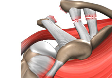 Thoracic Outlet Syndrome