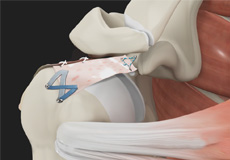 Thoracic Outlet Syndrome