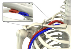 Thoracic Outlet Syndrome