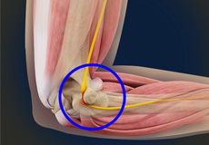 Thoracic Outlet Syndrome