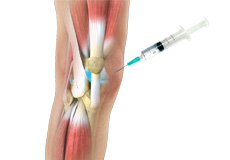 Anterior Knee Pain